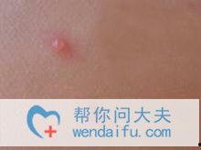 水痘可以吃羊瓜吗,水痘期间适宜食用的羊瓜推荐